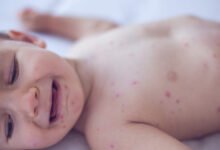Measles killed 6-week-old baby, coroner confirms after RFK Jr. disputed deaths