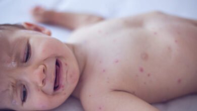 Measles killed 6-week-old baby, coroner confirms after RFK Jr. disputed deaths
