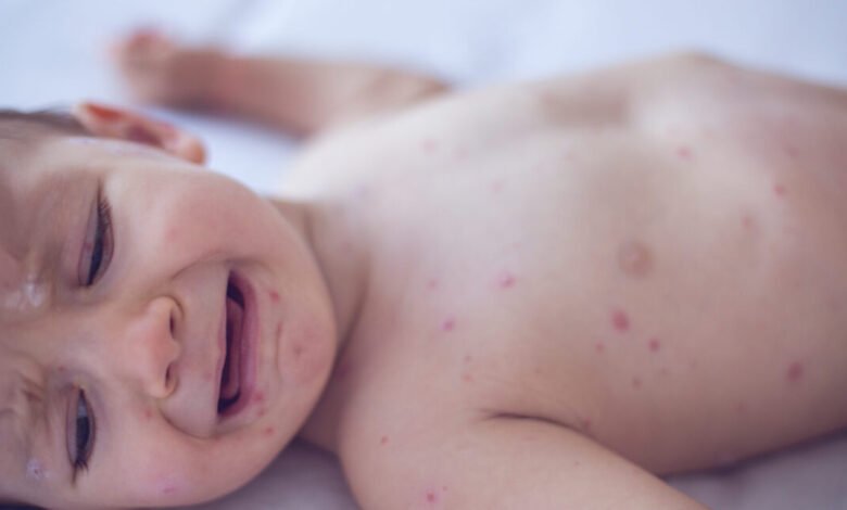 Measles killed 6-week-old baby, coroner confirms after RFK Jr. disputed deaths Measles killed 6-week-old baby, coroner confirms after RFK Jr. disputed deaths