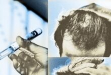 Could Your GLP-1 Be Making You Bald? One Study Says Maybe