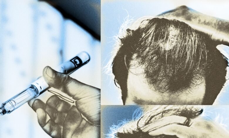Could Your GLP-1 Be Making You Bald? One Study Says Maybe Could Your GLP-1 Be Making You Bald? One Study Says Maybe