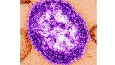 Pennsylvania says an unvaccinated girl has died from measles